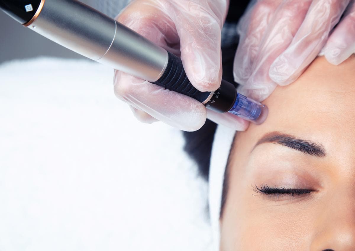 Microneedling In Geneva