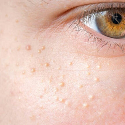 Microneedling 5 barley grains traitement microneedling geneve