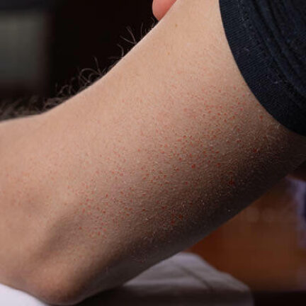 Microneedling 7 keratosis pilaris traitement microneedling geneve