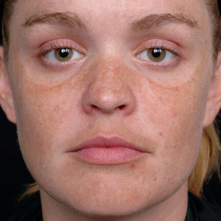 Microneedling 9 pregnancy mask traitement microneedling geneve