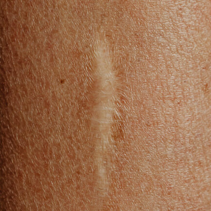 Microneedling 3 scar traitement microneedling geneve