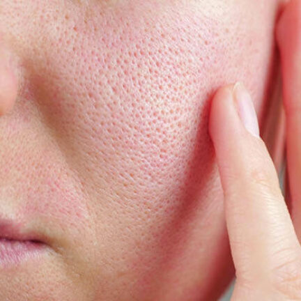 Microneedling 8 skin pores traitement microneedling geneve